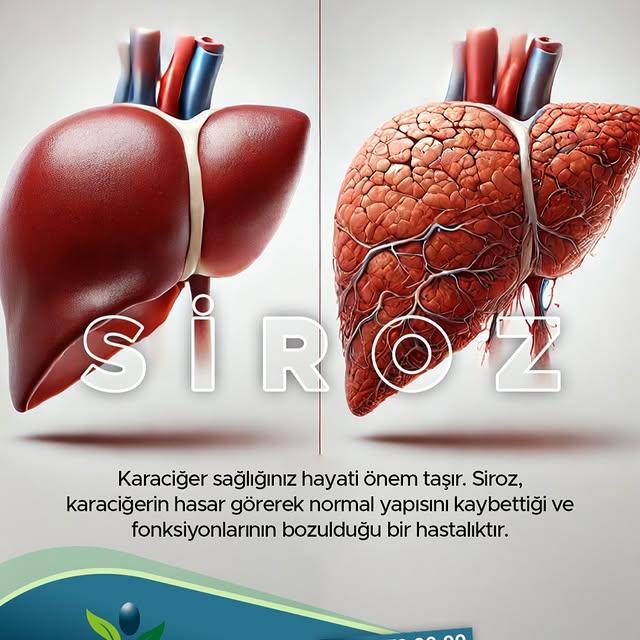 Karaciğer Sağlığınızı Koruyun: Siroz ve Önleme Yolları